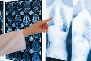 AI Revolutionizes Spinal Health Diagnostics with Automated X-ray Analysis